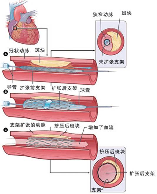 怎樣治療冠心??？(圖2)