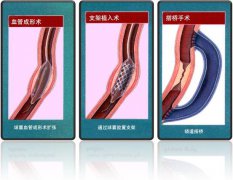 怎樣治療冠心??？