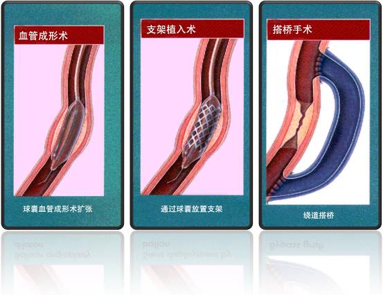 怎樣治療冠心??？(圖1)