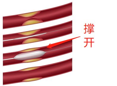 什么是藥物球囊？(圖2)